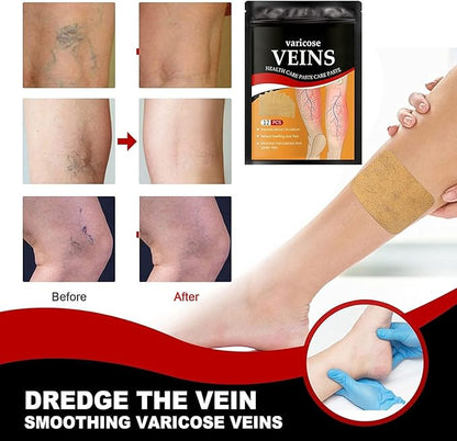 Varicose Vein Patches | Herbal Therapy for Swelling, Fatigue | 12 PCS